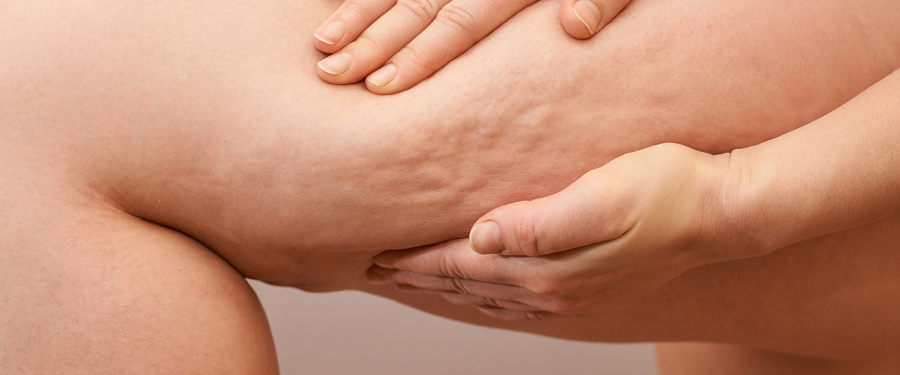 Celulitis, como eliminarla